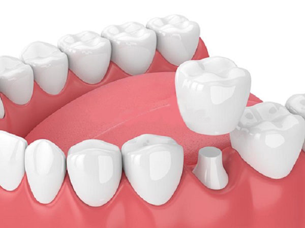 Những cách chữa trị cho răng bị vỡ mẻ